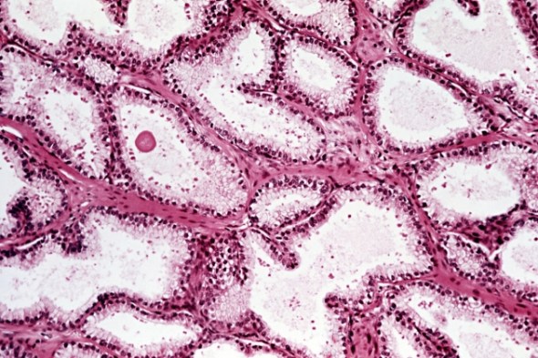 慢性前列腺炎/慢性盆腔疼痛综合征(CP/CPPS)