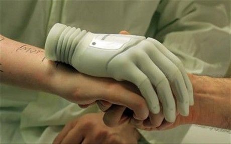 奥地利男子切除坏手装仿生手