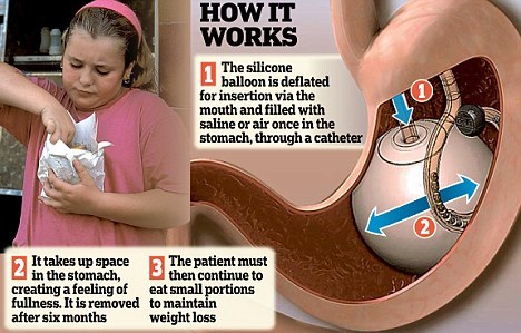 英医学专家欲尝试胃内水球法治疗儿童肥胖