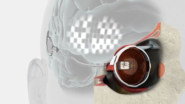 世界首例仿生眼植入者恢复部分视力(图)