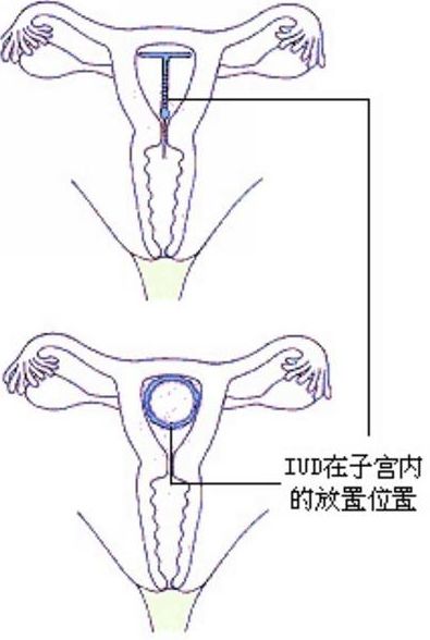 送环入宫腔及安置妥当后示意图