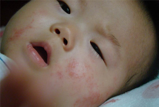 专家解读宝宝湿疹常见问题