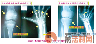 让孩子更有竞争优势 昆明兴起"拔苗"助长医生:盲目助长会适得其反