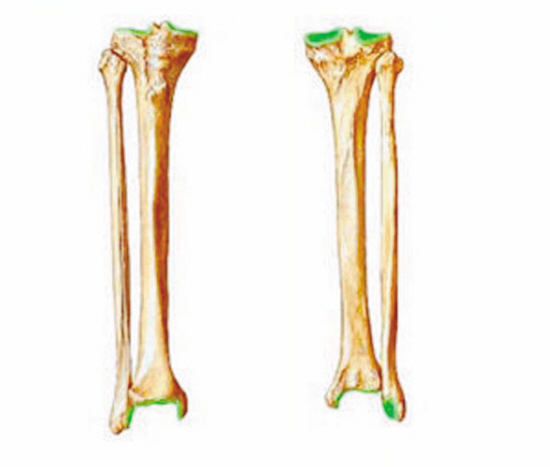 腓骨变胫骨不用拄拐了