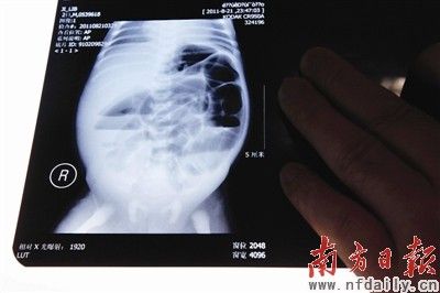 > 正文  在医院公布的资料中,腹部立位平片显示患者可能有肠梗阻