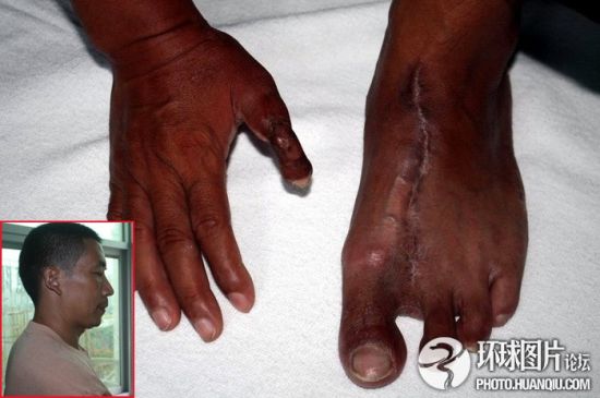 睾丸呈  正常成人的睾丸有多大问:问下答:睾丸是什么样子的?