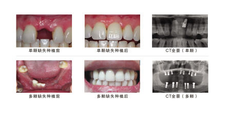 80岁老人欲改年龄做种植牙_新浪新闻