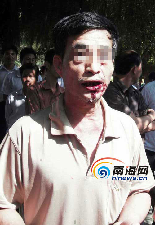 周某满嘴是血(南海网记者 李晓梅摄)