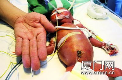 手掌婴儿体重900克 接受心脏手术