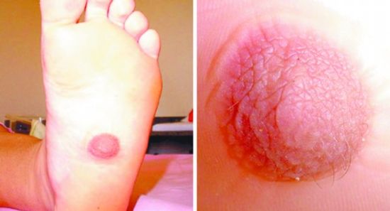 脚底板上长出<em>乳头</em> 巴西女子奇体为全球首例_新