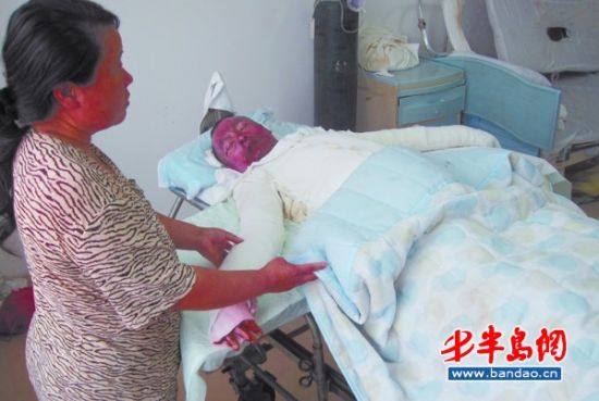 煤气泄漏遇炉火突爆燃打工男子全身重度烧伤