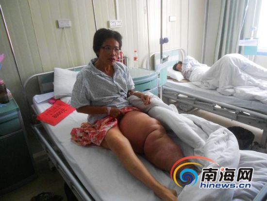 三亚单身母亲患“大象腿”社会捐款10万元救急