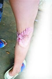 记者王闯 摄□见习记者 王闯□实习生 莫凡"小孙子去年做了植皮手术