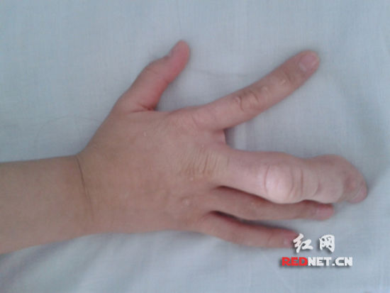 (芳芳右手的中指,左脚的大踇趾既粗又长,比正常的手指大了一倍多)