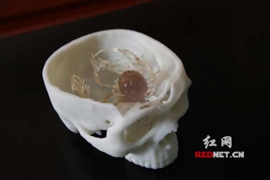 3D打印“克隆”颅内肿瘤 高难手术不再凭空想象