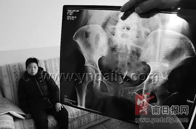 女子三次手术后发现盆腔内留有缝合针(图)