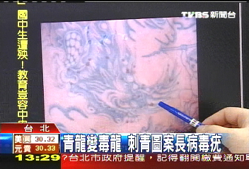 青龙变<em>毒龙</em>+台湾一男子刺青图案长病毒疣