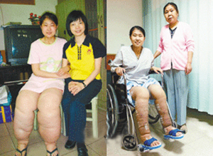 女孩患怪病双腿重100斤续:治愈后能穿仔裤