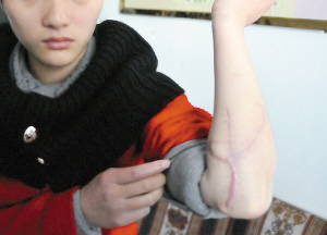 陈超的暴行，在张丽手臂上留下了疤痕。酉阳县检察院供图