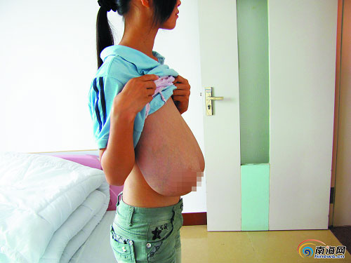 16岁少女患巨乳症双乳重达16斤(图)