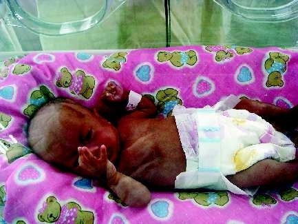 婴儿出生仅成人手掌大小经两个月救治成活(图)