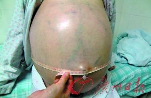 图为患者手术前腹部照片.