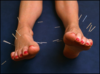A pair of feet with acupuncture needles in them