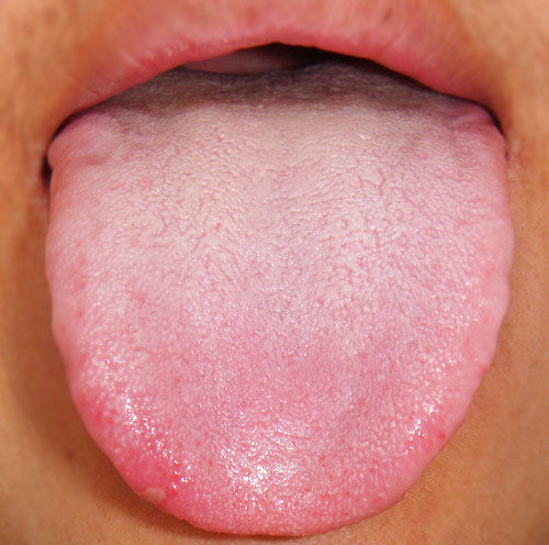 舌尖上的健康看舌头知内火