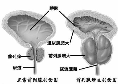 多练提肛护前列腺