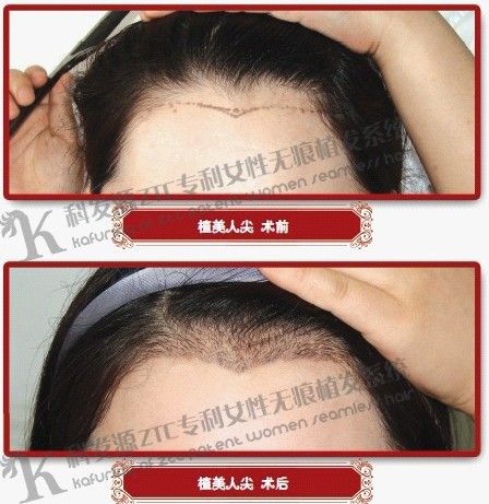科发源植发:女性<em>头发加密</em>有用吗 如何选择<em>技术</em>