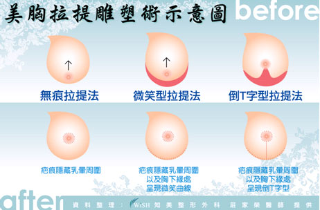 缩胸手术视原乳房大小与欲缩减的尺寸不同