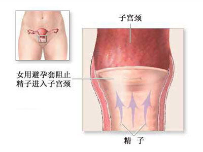 女性避孕套的避孕机制