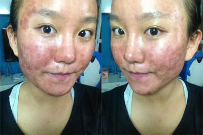 达人分享激光祛痘私密过程