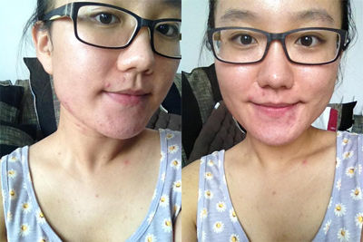 达人分享激光祛痘私密过程