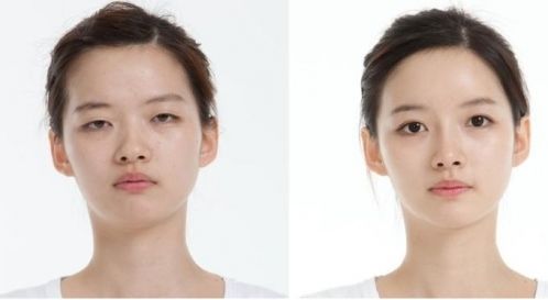双眼皮手术前后对比图