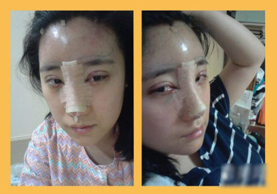 图揭网友割双眼皮+隆鼻 手术前后整容经历|双眼
