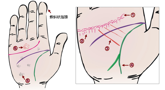 心脏病手相