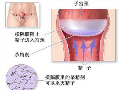 使用外用避孕药物要注意什么