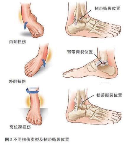 足踝扭伤需遵循PRICE原则 平时预防也很关键