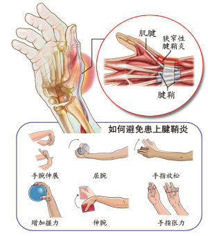 智能手機催生狹窄性腱鞘炎