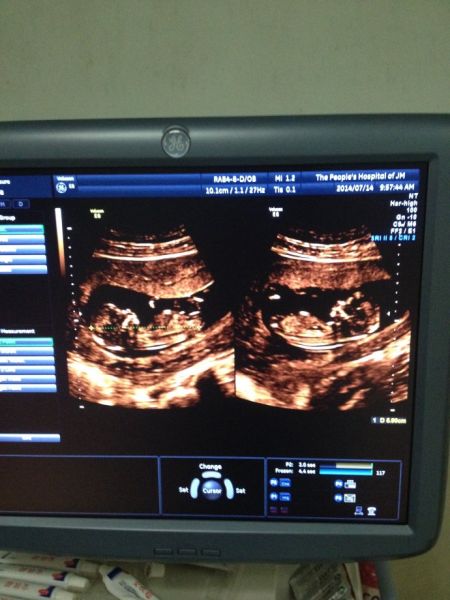 双胞胎b超图孕早期图片