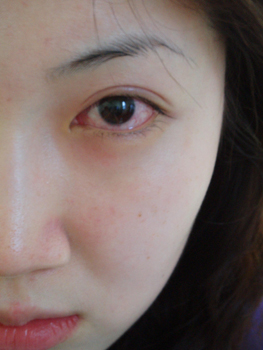 昆明医生提醒:警惕红眼病