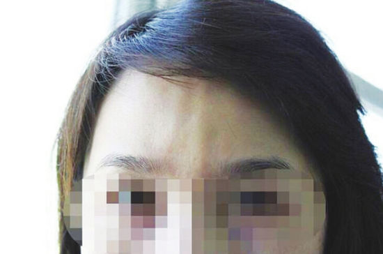 新疆库尔勒一女子除皱失败额头鼓起两个包