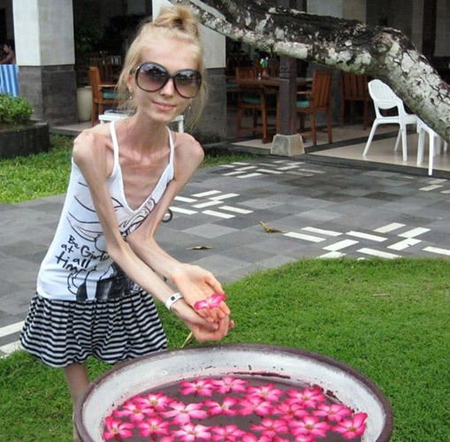 俄罗斯20岁女孩减肥后仅剩20公斤(组图)