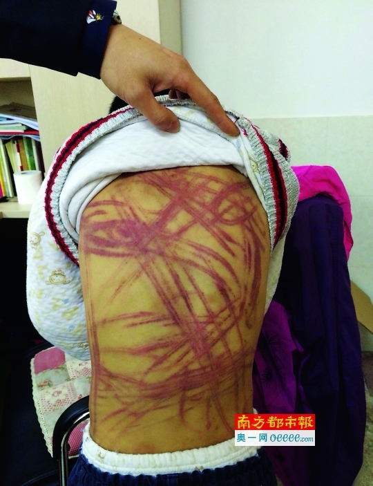 男童未完成作业遭养母耙打绳抽脚踩