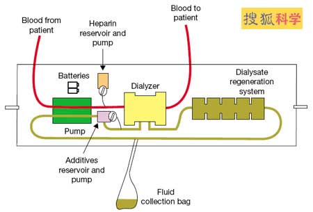 新型人造肾脏测试成功 可挽救50%病人生命