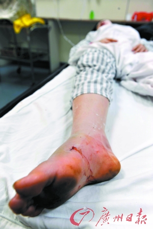 赤脚登山 女子被毒蛇咬伤