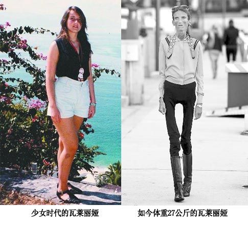 岁的俄裔摩纳哥女子瓦莱丽娅·莱维汀由于疯狂的节食减肥患上了厌食症