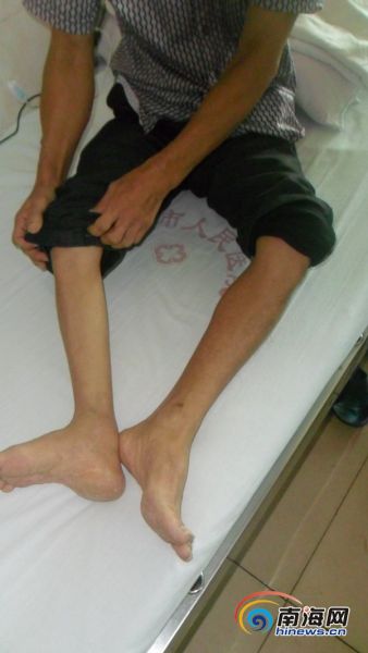 文昌市会文镇沙港村委会的谭振潘是一名患有小儿麻痹症的患者,三岁