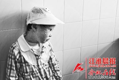 据江淮晨报报道,7个月的早产女婴幸运地活了下来,却不幸患上了鱼鳞病